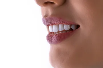 Избелване на зъби